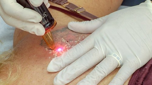 What Actually Happens to Your Skin During Laser Tattoo Removal | Flipboard