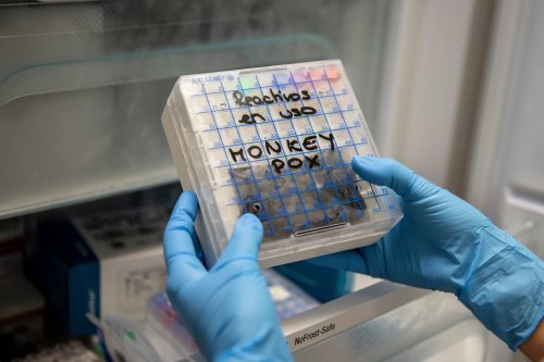 La variole du singe détectée pour la première fois chez un enfant en France