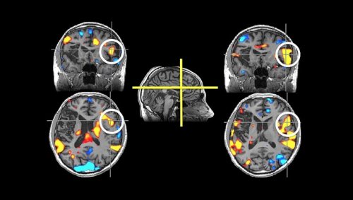 Des scans cérébraux pour prédire le succès d'une psychothérapie?