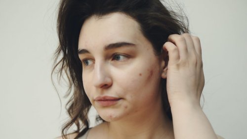 L'acné adulte existe aussi et la plupart des gens ne savent pas quoi faire