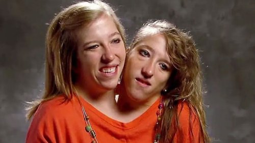 Conjoined Hensel twins targeted with fake post alleging they shared details about sex lives
