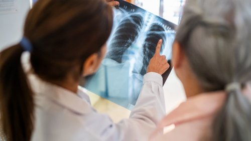 Wie groß ist die Tuberkulose-Gefahr in Deutschland?
