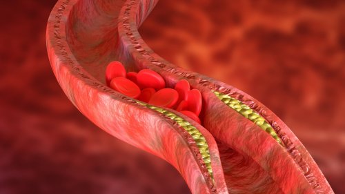 Atherosklerose: Gefäßschäden haben direkten Draht ins Hirn