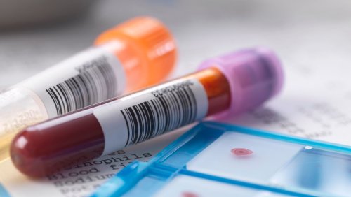 Untersuchung von Blut und Urin: Forscher entwickeln Methode zur Früherkennung von 14 Krebsarten