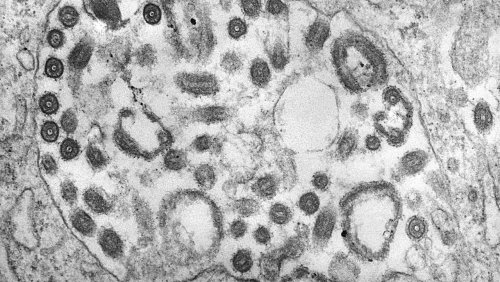 Ausbruch von Marburg-Fieber: Fünf Tote nach Infektion im Nordwesten von Tansania