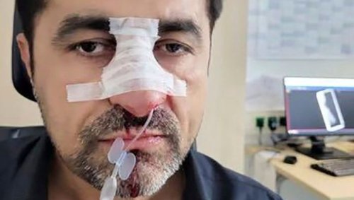 Mit Kopfstoß die Nase gebrochen: Rassistische Attacke auf Bayreuther Stadtrat – Haftstrafe für 35-Jährigen