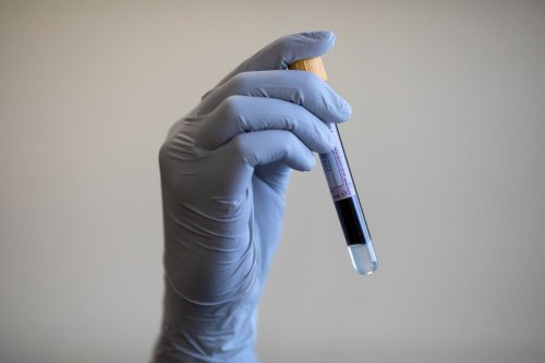 New blood test for prostate cancer is 94% accurate, researchers say