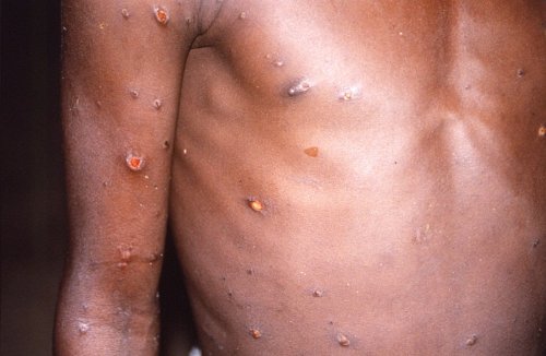 Number of monkeypox cases in UK beginning to plateau, figures suggest