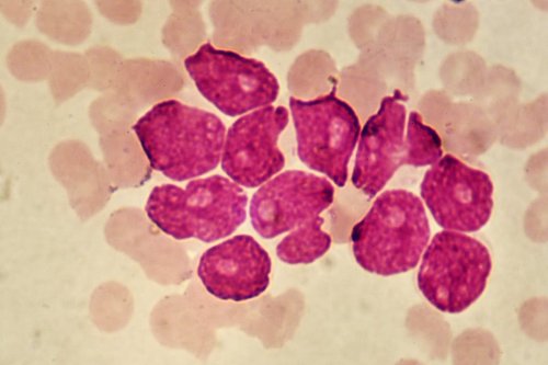 Scientists discover ‘Achilles heel’ in deadly blood cancer that could boost treatment