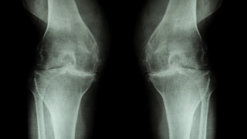 Common injections don’t help knee osteoarthritis more than placebo, large data review finds