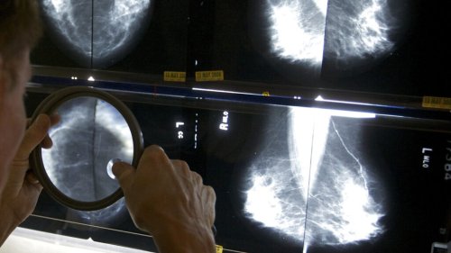 Advanced cancers returned to pre-pandemic levels, according to a reassuring report