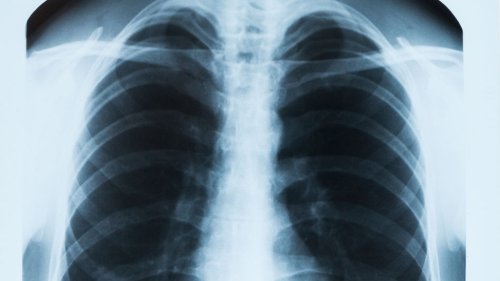 Steroid drug reduces death rate in severe pneumonia, study shows