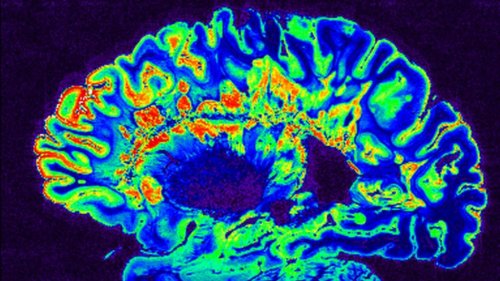 Novartis multiple sclerosis treatment cuts rates of relapse in pivotal trials