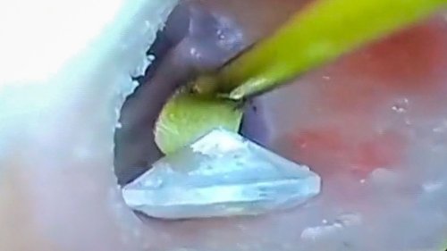 Kleines Vermögen im Ohr – Arzt fischt Frau einen Diamanten aus dem Gehörgang