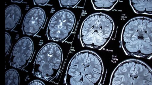 Neuer Schnelltest analysiert Hirntumore im Eiltempo