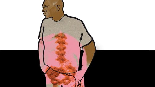 Ein Mann hat Rückenschmerzen, manche seiner Knochen sehen "zerfressen" aus. Steckt ein Tumor dahinter?