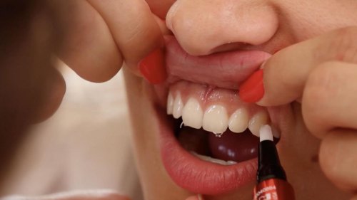 "Weiße Zähne über Nacht":  Was kann das 20-Euro-Gadget aus der Drogerie?