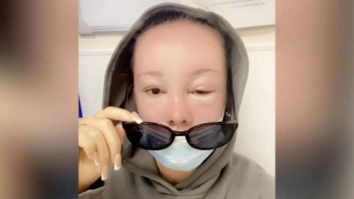 Frau erleidet Sonnenvergiftung und bekommt ihre Augen kaum noch auf