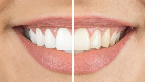 Zähne aufhellen: Diese Bleaching-Methoden gibt es