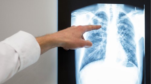 Tuberkuloseausbruch in Chemnitz weitet sich aus