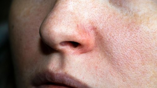 Rosacea-Creme gegen Hautrötungen: Diese Produkte sollen die Symptome lindern