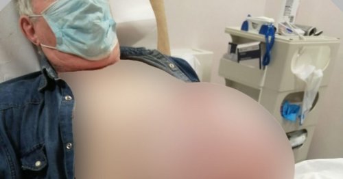 Farmer's hernia swells to size of football after op delays