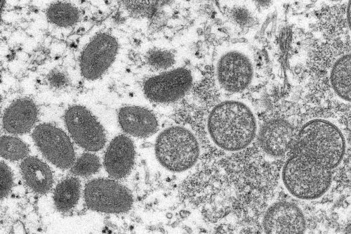 Monkeypox virus could become entrenched as new STD in the U.S.