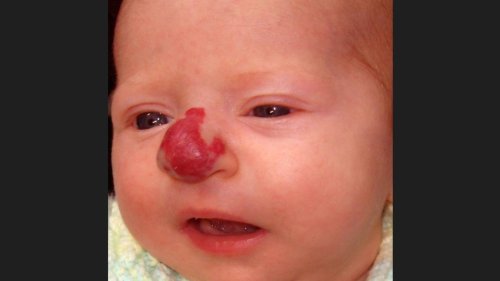 'Massive need' for new strawberry birthmark treatment