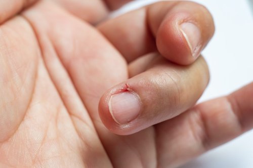 Nietnagel am Fingernagel loswerden – die besten Tipps vom Arzt