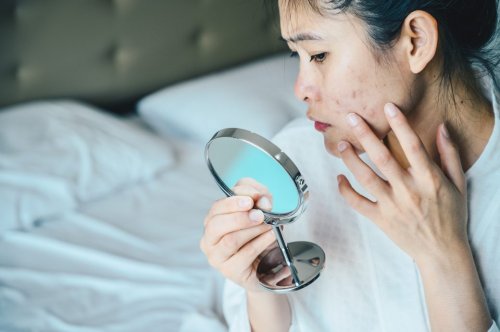 Ist „Micro Concealing“ der Trick, um Aknenarben verschwinden zu lassen?