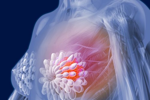 Brustkrebs – Entstehung der Krankheit, Risikofaktoren und Vorsorge