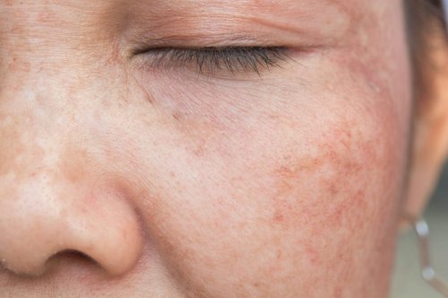 Wie beugt FRAU dunklen Pigmentflecken im Gesicht vor?