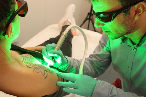 Tatouage : comment l’enlever de votre peau et combien ça coûte ? Tout ce qu’il faut savoir