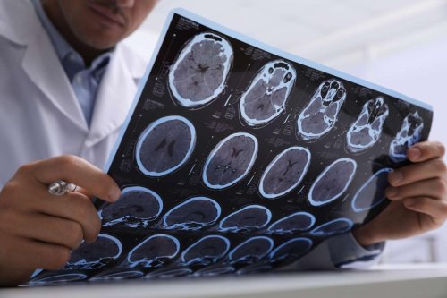 Sclérose en plaques : l’effet protecteur de fortes doses de vitamine D