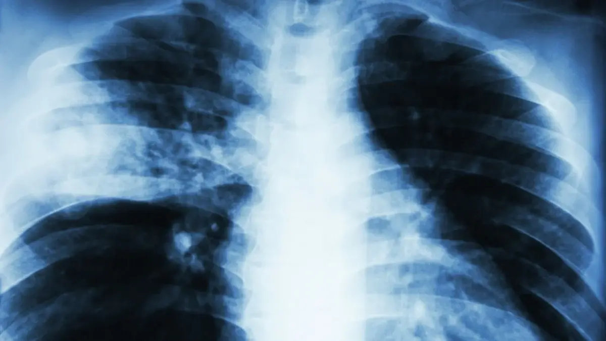 Forscher befürchten Millionen Tuberkulose-Tote