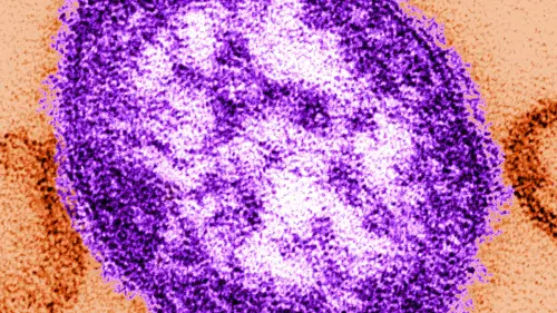 Masernfall im Raum München: Gesundheitsamt hält weitere Infektionen für möglich