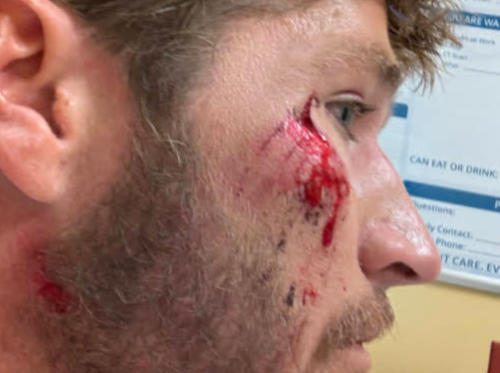 Big Wave Surfer Nathan Florence Just Got 9 Stitches in His Face