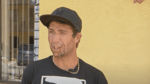 Surfer Says Gold Chain Caused Shark Attack on His Face (Video)
