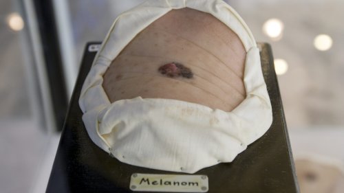 Bern scientists develop promising hydrogel treatment for melanoma
