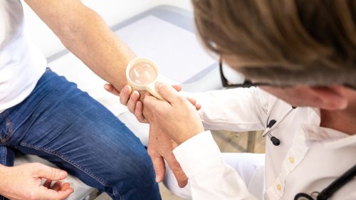Hautkrebs auf dem Vormarsch: Was sind die Ursachen, worauf sollte man achten?
