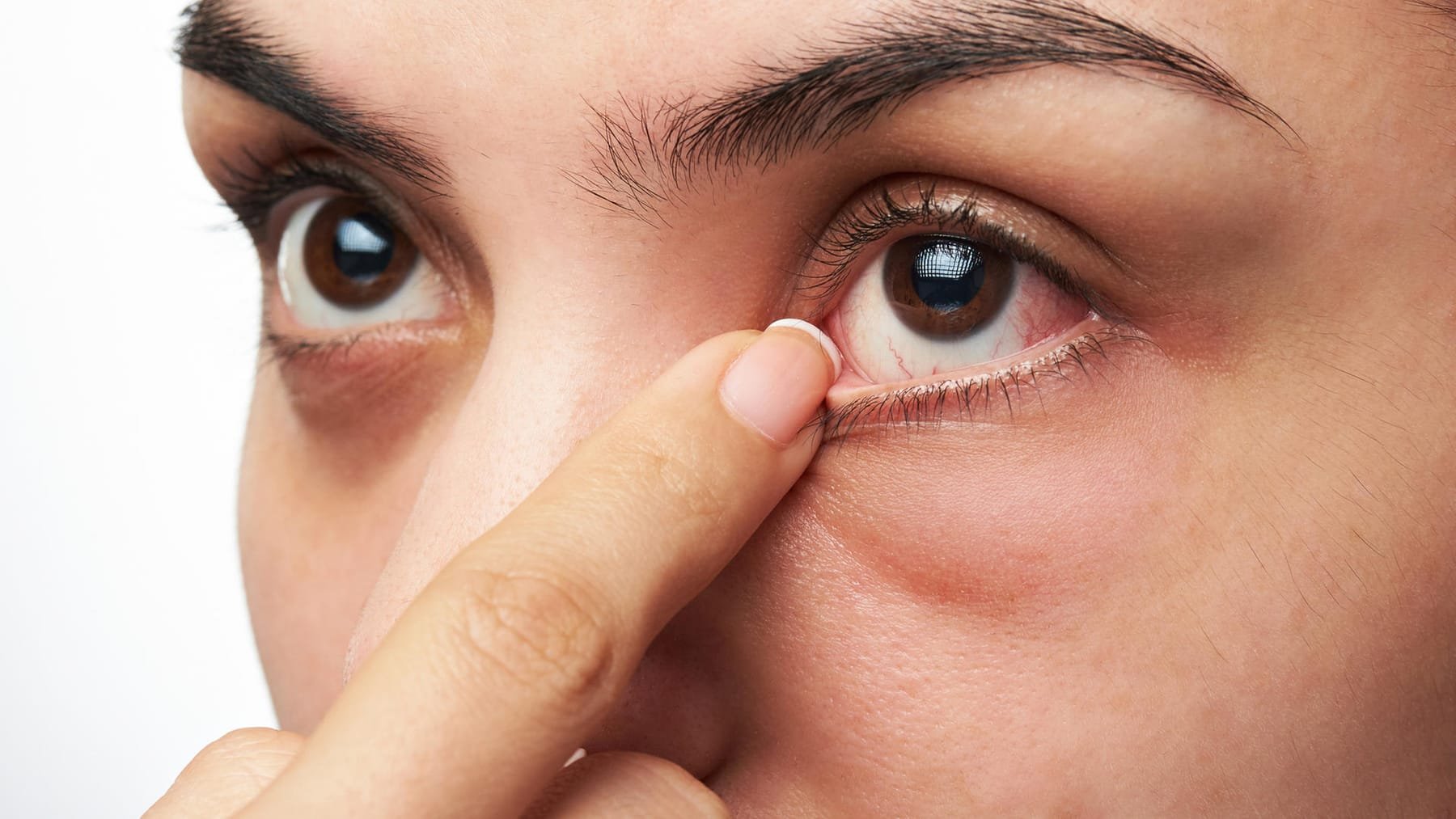 Zehn Tipps gegen geschwollene Augenlider und Tränensäcke