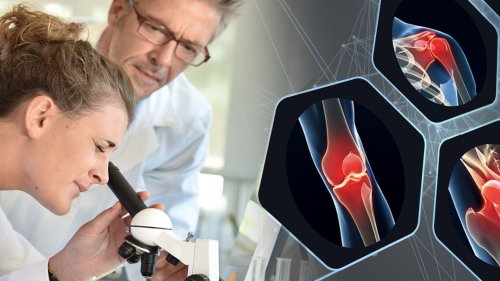 Erstaunliche Erkenntnis | Wirkstoff aus der Krebsforschung kann auch bei Arthrose helfen!