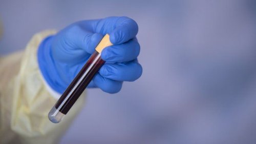 Krebs: Neuer Bluttest kann Erkrankung im Frühstadium entdecken | Studie
