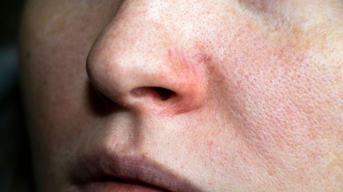 Hautkrankheit: Woher rote Äderchen im Gesicht kommen und was man tun kann