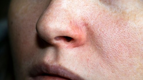 Rote Äderchen im Gesicht: Woher kommen die Hautveränderungen und was können Sie dagegen tun?