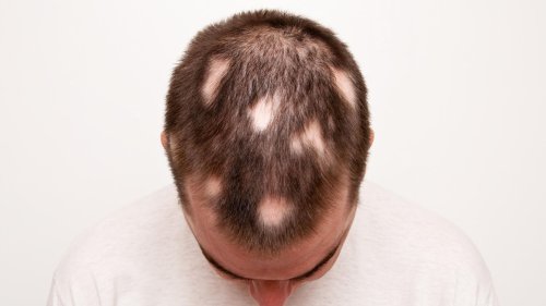 Kahle Stellen am Kopf: Alles zu kreisrundem Haarausfall