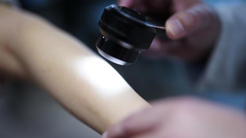 Hautärzte fordern staatliche Hautkrebsvorsorge