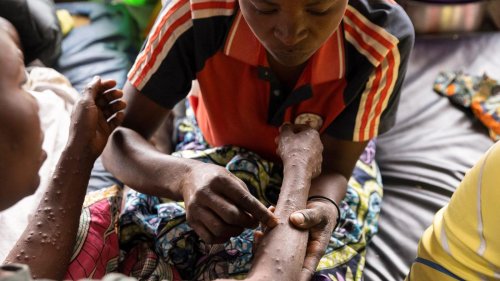 Neue Variante, neue Gefahr: Mpox breitet sich in Afrika rasant aus