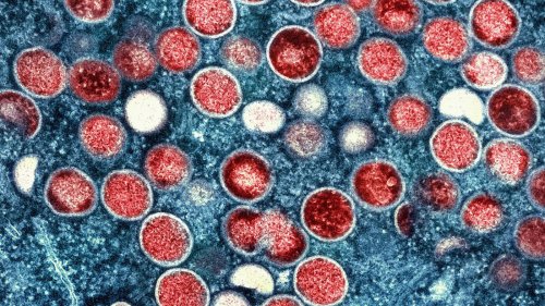 Krankheiten: Mehr Fälle von Mpox – aber Experte bislang gelassen