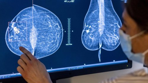 Mammografie künftig bis 75 Jahre: Frauen können nun länger zur Brustkrebsfrüherkennung